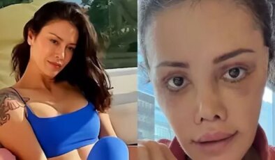 Yüz nakli yaptıran Didem Ceran’ın son hali: Harika gözüküyorum