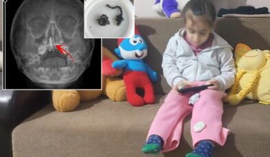 5 yaşındaki Polen yıllarca böyle yaşamış! Burnundan ameliyatla çıkardılar