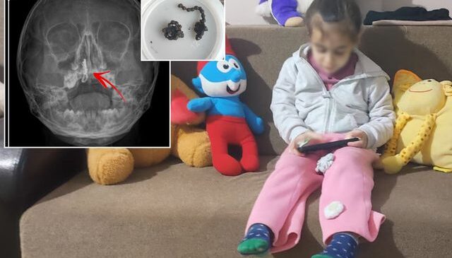 5 yaşındaki Polen yıllarca böyle yaşamış! Burnundan ameliyatla çıkardılar