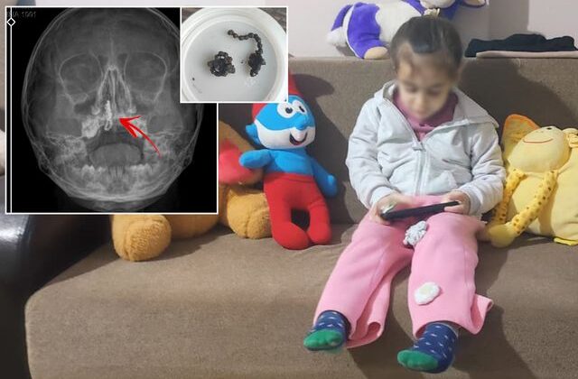 5 yaşındaki Polen yıllarca böyle yaşamış! Burnundan ameliyatla çıkardılar
