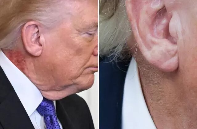 Trump’ın boynundaki kızarıklığı gizleme çabası
