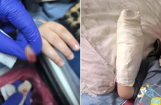 AVM’de yürüyen merdivene eli sıkışan çocuğun parmağı koptu