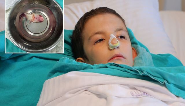 Burun tıkanıklığı şikayetiyle hastaneye gitti, ağzından dev bir polip çıkartıldı