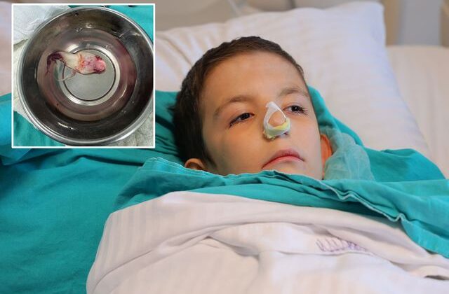 Burun tıkanıklığı şikayetiyle hastaneye gitti, ağzından dev bir polip çıkartıldı