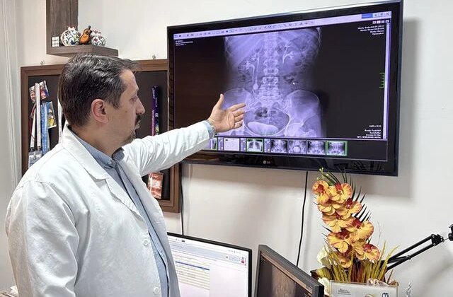 İdrar kanalından çıkan 51 taş, doktorları bile şaşkına çevirdi