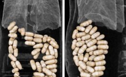 İzmir’de 2 şüphelinin midesinden 1 kilo 304 gram uyuşturucu çıktı