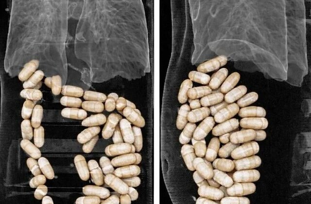 İzmir’de 2 şüphelinin midesinden 1 kilo 304 gram uyuşturucu çıktı