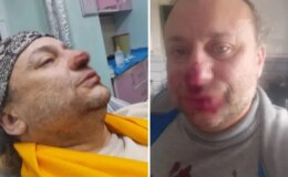 Onur Akay, başıboş pitbull köpeğinin saldırısında yaralandı