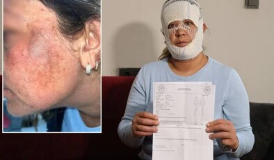 Prenses cilt bakımı yüzünü yaktı: Oğlum “öcü” deyip benden kaçıyor