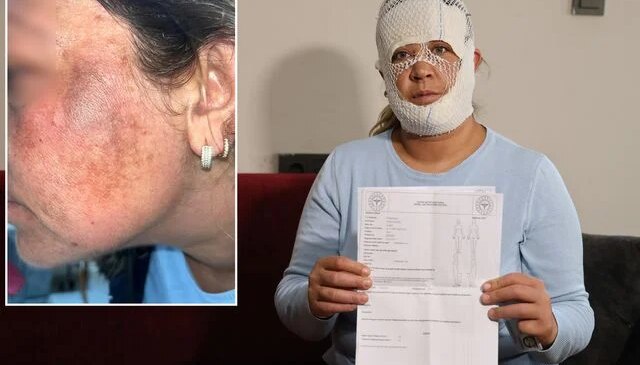 Prenses cilt bakımı yüzünü yaktı: Oğlum “öcü” deyip benden kaçıyor