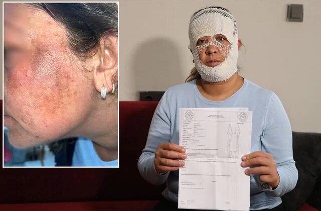 Prenses cilt bakımı yüzünü yaktı: Oğlum “öcü” deyip benden kaçıyor