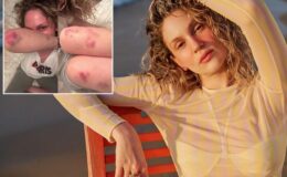 Farah Zeynep Abdullah’ın vücudundaki morluklar korkuttu