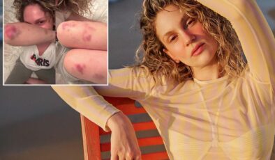 Farah Zeynep Abdullah’ın vücudundaki morluklar korkuttu