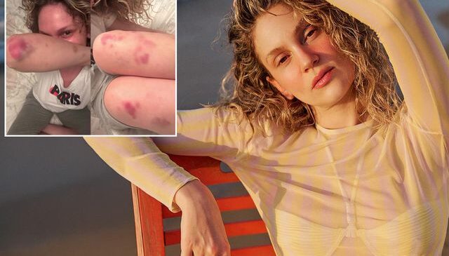 Farah Zeynep Abdullah’ın vücudundaki morluklar korkuttu