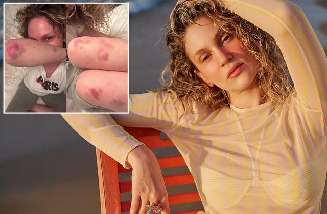 Farah Zeynep Abdullah’ın vücudundaki morluklar korkuttu