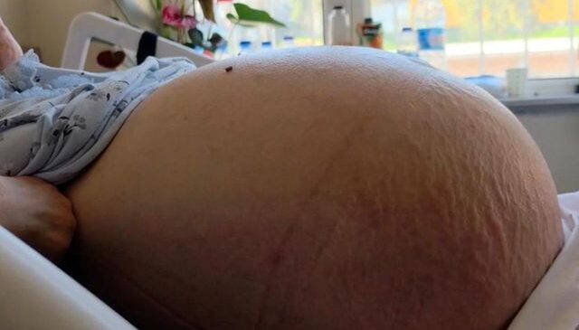 Doktorları bile şaşırtan vaka! Kabızlık sandı ama karnı burnuna geldi