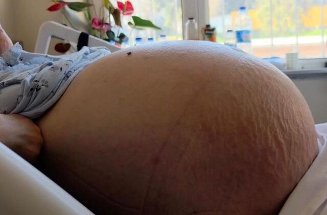 Doktorları bile şaşırtan vaka! Kabızlık sandı ama karnı burnuna geldi