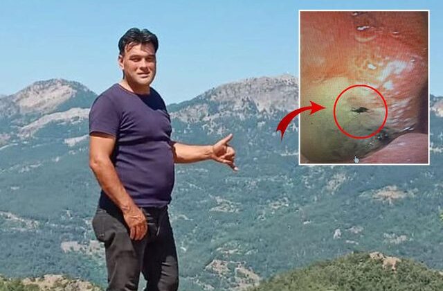 Kabus gibi olay! Midesinden canlı böcek çıkarıldı
