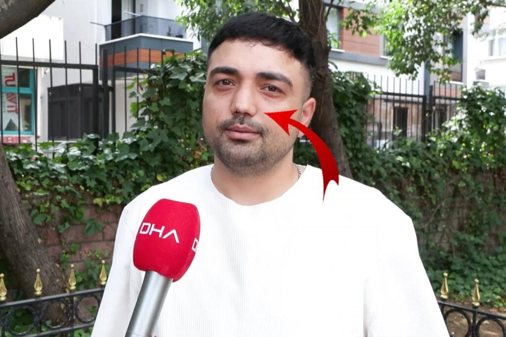 Burun ameliyatı sonrası deformasyon ve iş kaybı