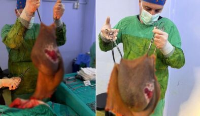 Bu kitle bir insanın karnından çıktı! Doktor tek başına kaldıramadı