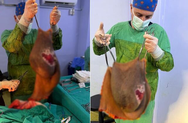 Bu kitle bir insanın karnından çıktı! Doktor tek başına kaldıramadı