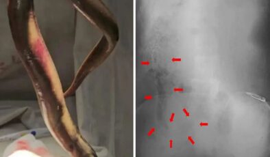Avlanırken makatından vücuduna yılan balığı girdi! Ameliyatta canlı çıkarıldı
