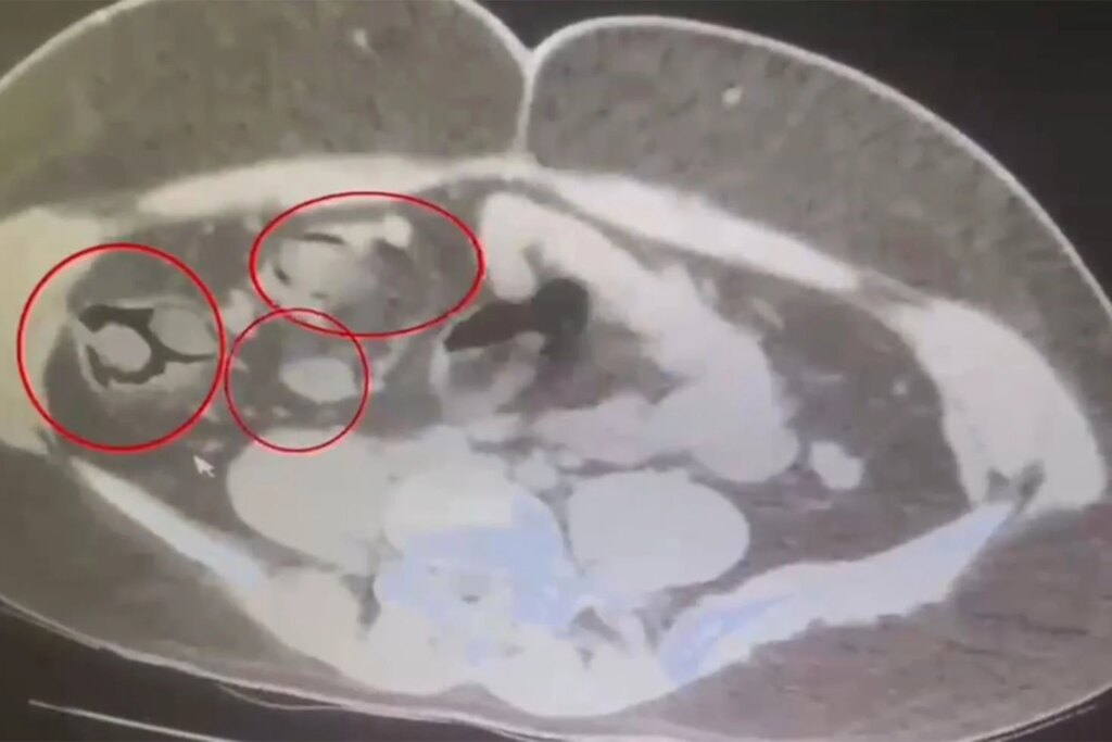 Kars'ta İranlı şüphelinin midesinden 76 kapsül metamfetamin çıktı