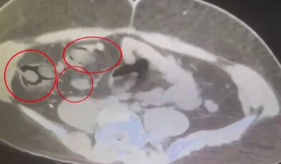 Kars’ta İranlı kuryenin midesinden 76 parça metamfetamin çıktı