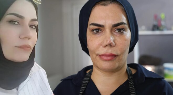 Burun estetiği faciayla sonuçlandı: Kadının hayatı kabusa döndü
