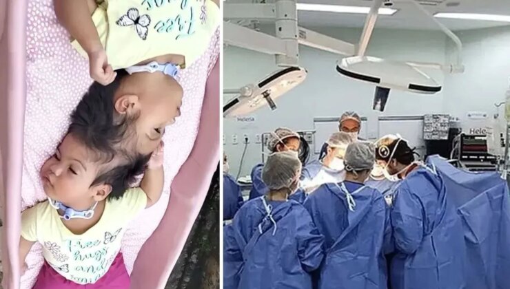 Yapışık ikizlerden acı haber: Kalpleri 14 dakika arayla durdu